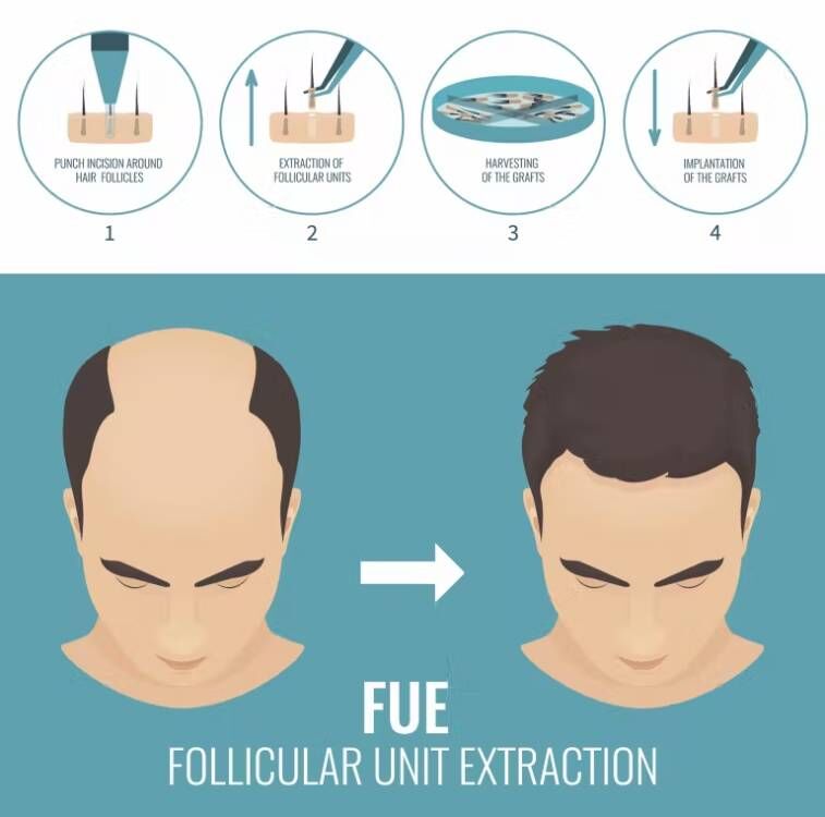 FUE Hair Implant Micro Motor H - Hair Care Vegan review and price